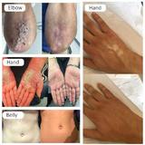 aparat-tratare-psoriasis-vitiligo-herpes-eczeme-dermatita-atopica-phototerapie-308nm-xeci-lampa-uvb-profesional-xcn-3.jpg